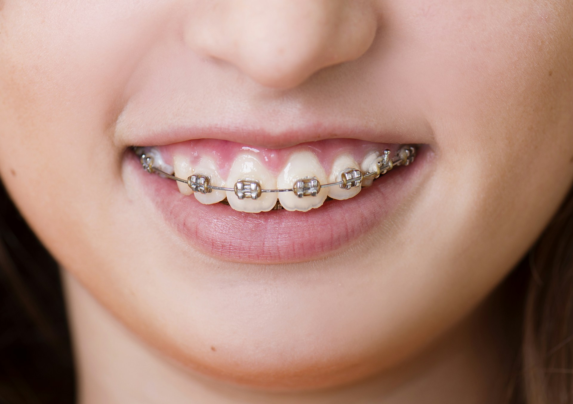 Child's Braces